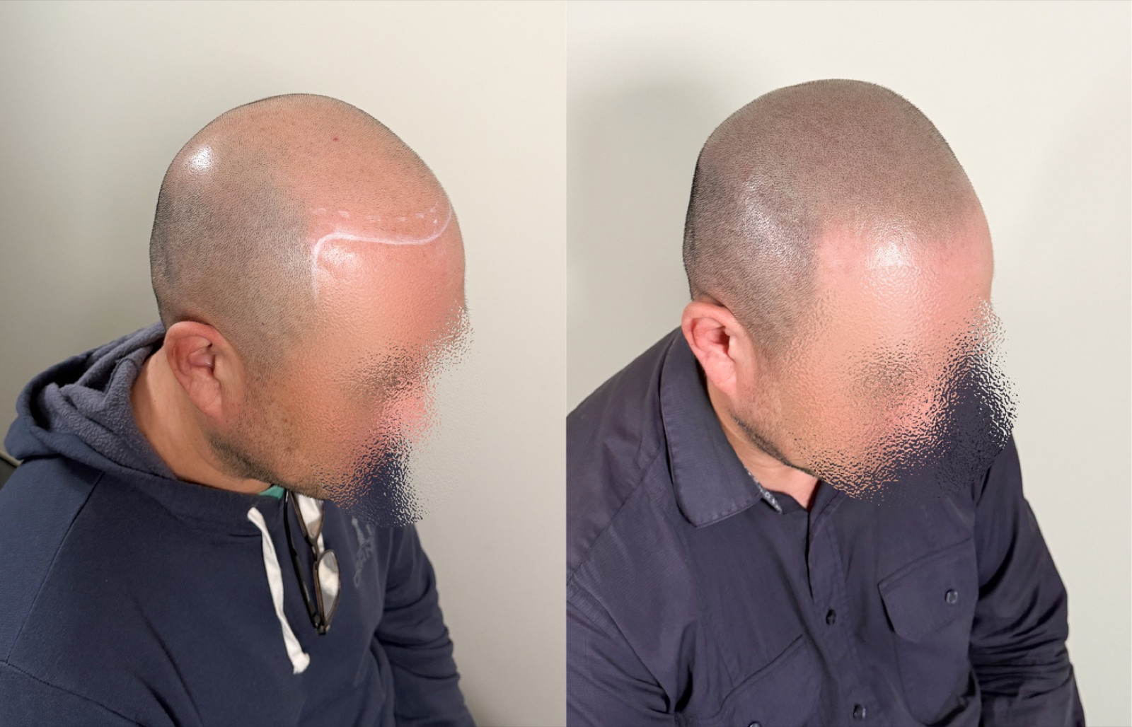 Shaved look SMP portfolio 2